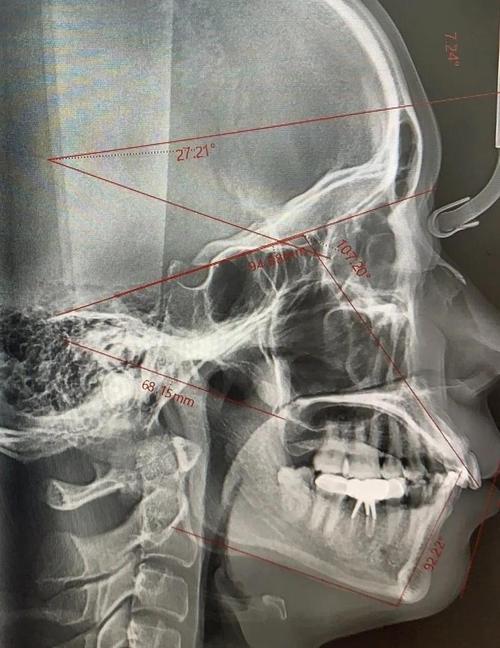 矫正牙齿不拍片真的可以吗？不拍片会影响矫正效果和安全性吗？-图2