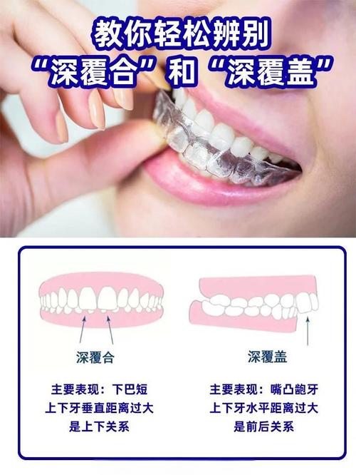 深覆合牙齿矫正到底有没有必要做？-图3
