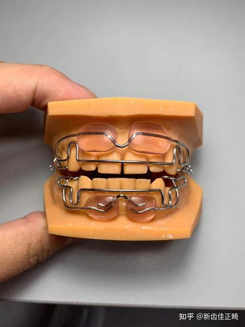 牙齿矫正器品牌有哪些?热门品牌大盘点!-图1 牙齿矫正器品牌有哪些?热门品牌大盘点!-图1