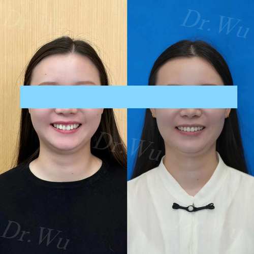 牙齿隐形矫正一般需要多长时间才能完成?-图3 牙齿隐形矫正一般需要多长时间才能完成?-图3
