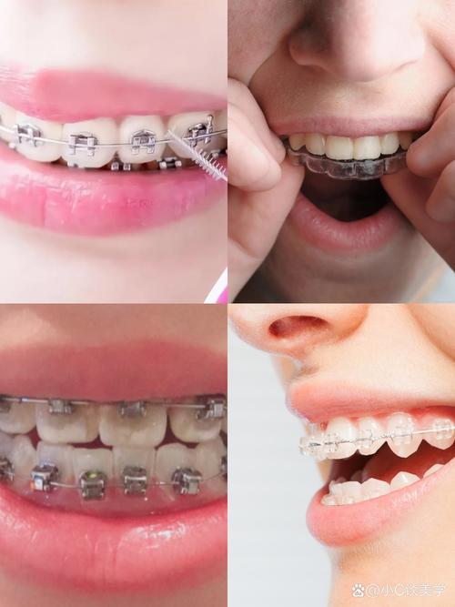 三十多岁矫正牙齿还来得及吗？年龄是阻碍吗？-图2