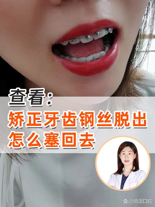 矫正后牙齿变形了,该如何有效解决?-图1 矫正后牙齿变形了,该如何有效解决?-图1