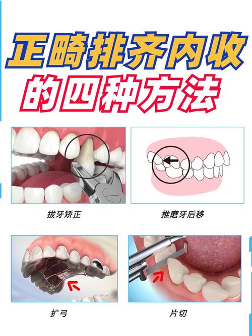 矫正牙齿会拔门牙吗?-图3 矫正牙齿会拔门牙吗?-图3