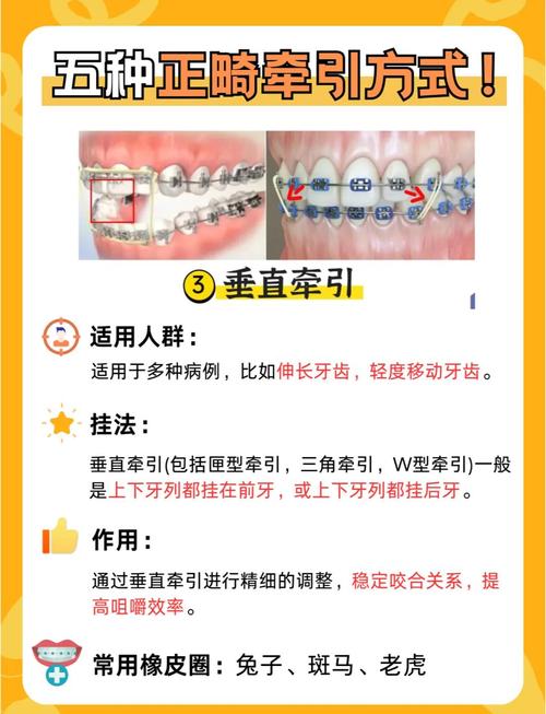 牙齿矫正橡皮圈的作用是什么？为何医生总让戴？-图1