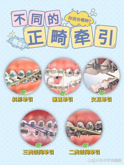 牙齿矫正橡皮圈的作用是什么？为何医生总让戴？-图3