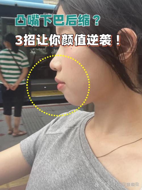 矫正牙齿对下巴的改变有多大？疑问解析-图3