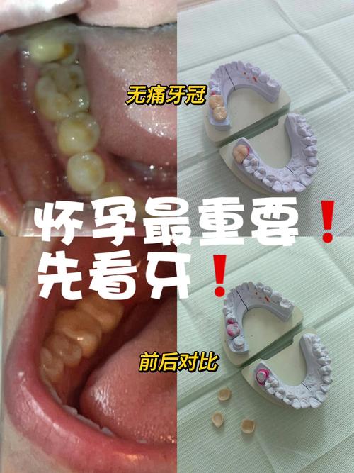 怀孕期间矫正牙齿可行吗？对胎儿有影响吗？-图1