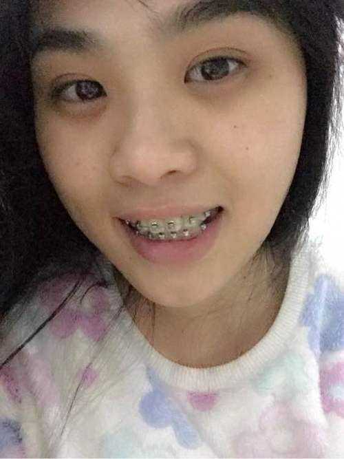 22岁能不能矫正牙齿？成年人矫正还来得及吗？-图3