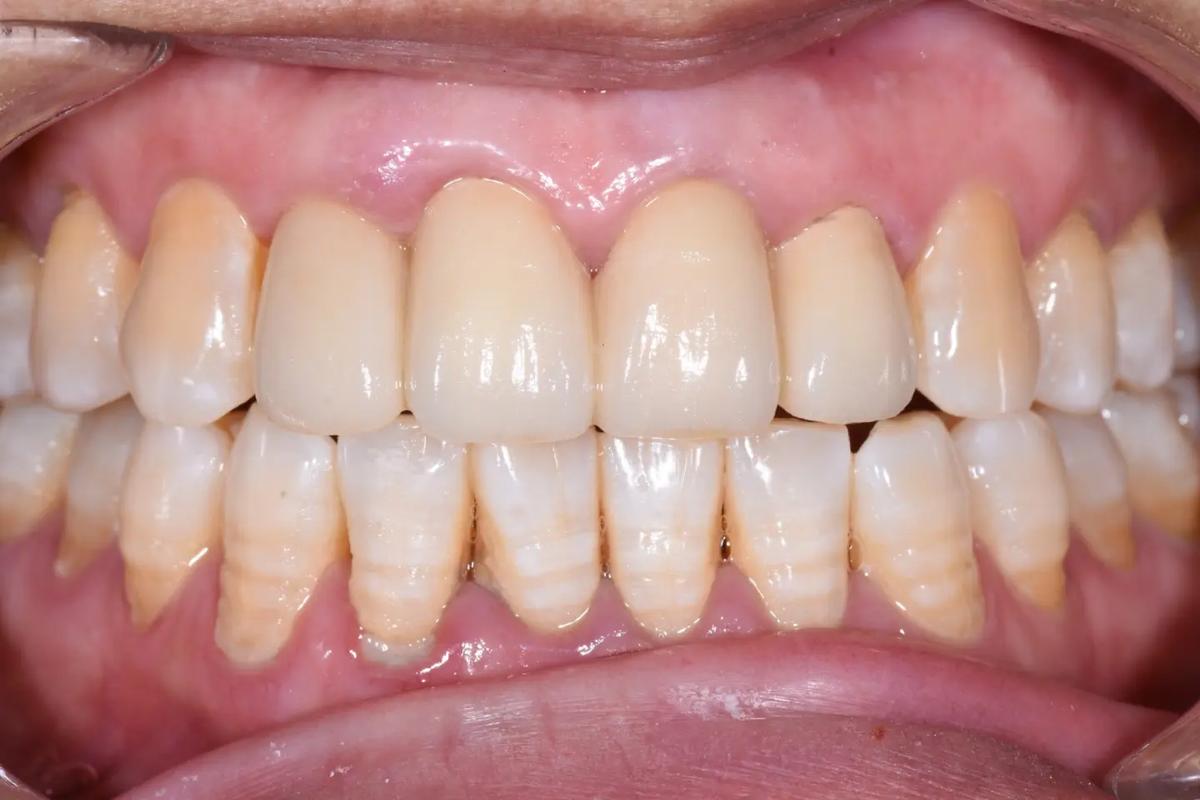 牙齿矫正美容冠是矫正牙齿还是美容修复？-图2