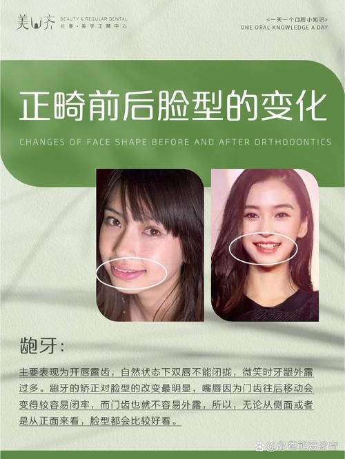牙齿矫正改变脸型,图片效果真有这么神?-图1 牙齿矫正改变脸型,图片效果真有这么神?-图1