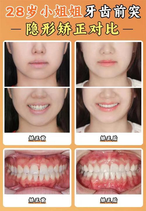 30多岁能矫正牙齿吗-图1