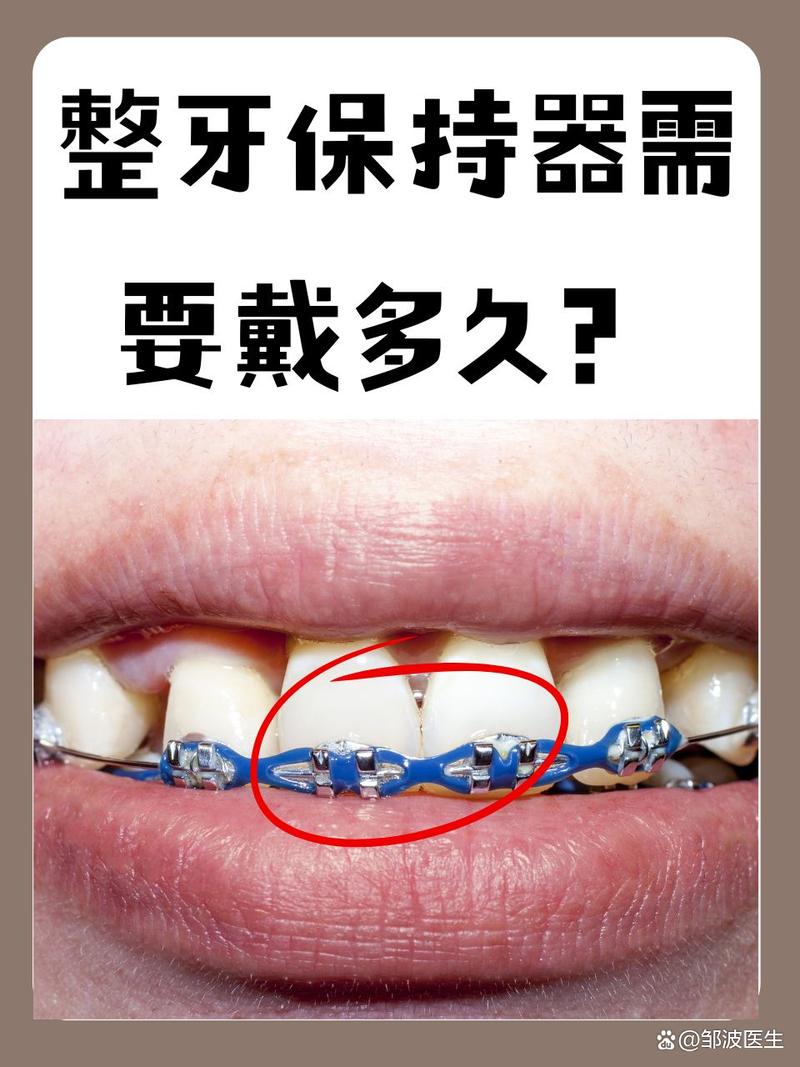 矫正牙齿后，保持器到底要戴多久？-图2