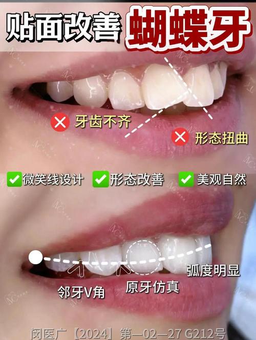 牙贴面能矫正牙齿吗?效果和局限有哪些?-图3 牙贴面能矫正牙齿吗?效果和局限有哪些?-图3