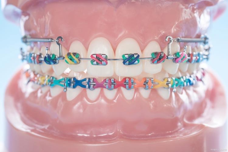 矫正牙齿会影响口腔健康和面部美观吗？利弊有哪些？-图1