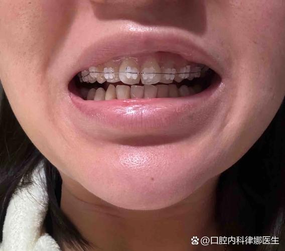 26岁牙齿矫正，危害有哪些？-图3