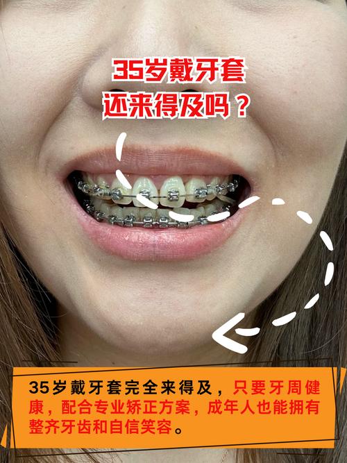 35岁矫正牙齿,现在开始还来得及吗?-图2 35岁矫正牙齿,现在开始还来得及吗?-图2