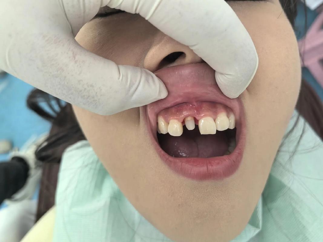 美容冠矫正牙齿的图片-图2