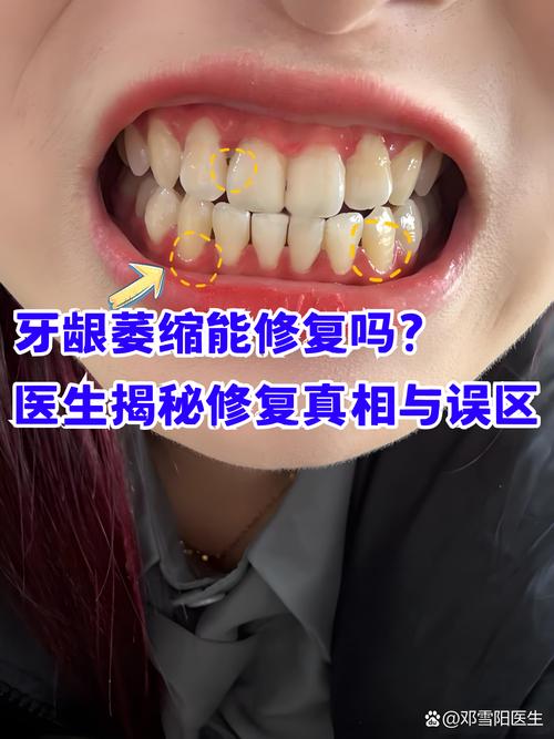 牙齿矫正会导致牙龈萎缩吗？-图1