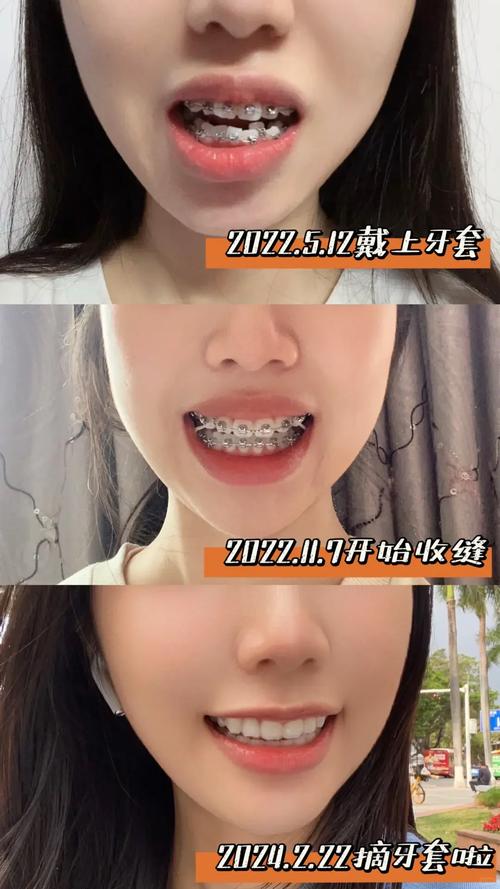 30岁还能矫正牙齿吗？-图1