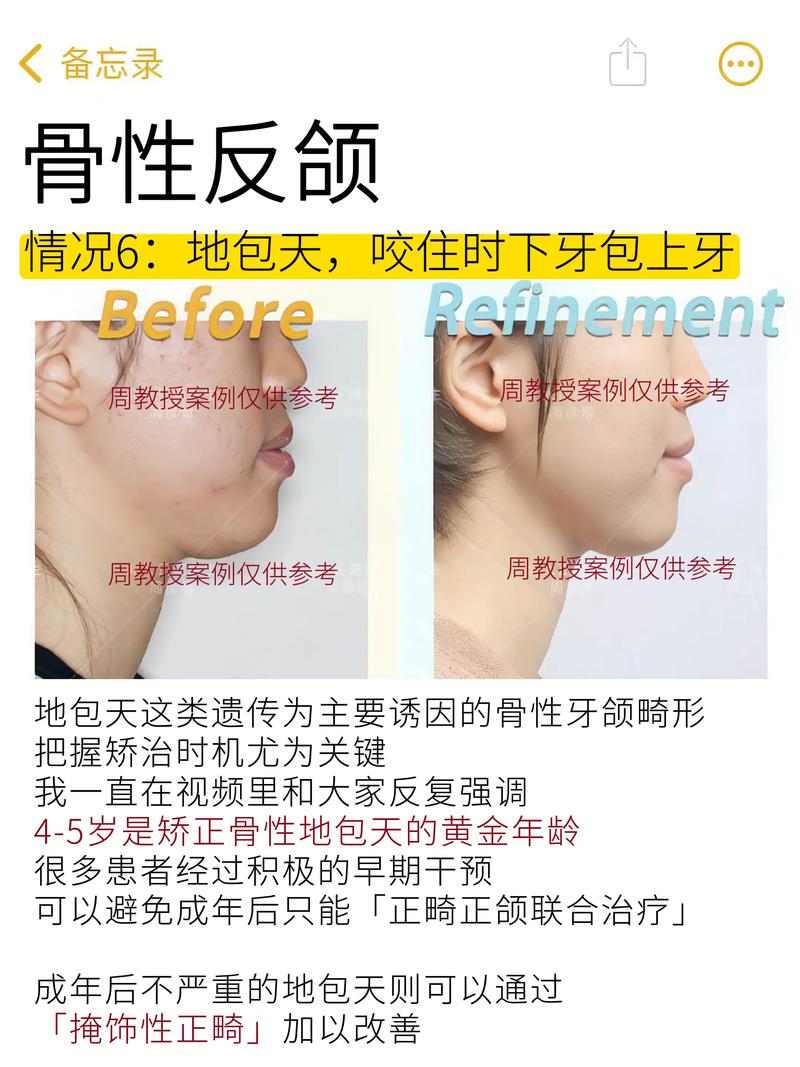 成人牙齿矫正后,反弹的可能性有多大?-图1 成人牙齿矫正后,反弹的可能性有多大?-图1