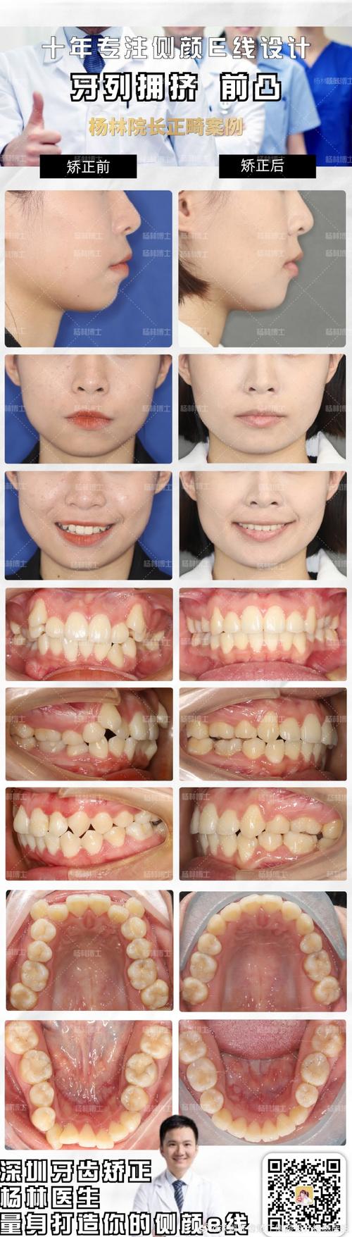 深圳牙齿矫正去哪里好？求专业靠谱的机构推荐！-图2