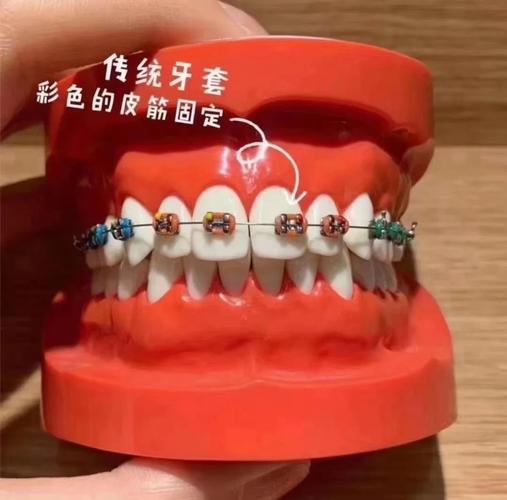 22岁矫正牙齿一般需要多长时间？-图1