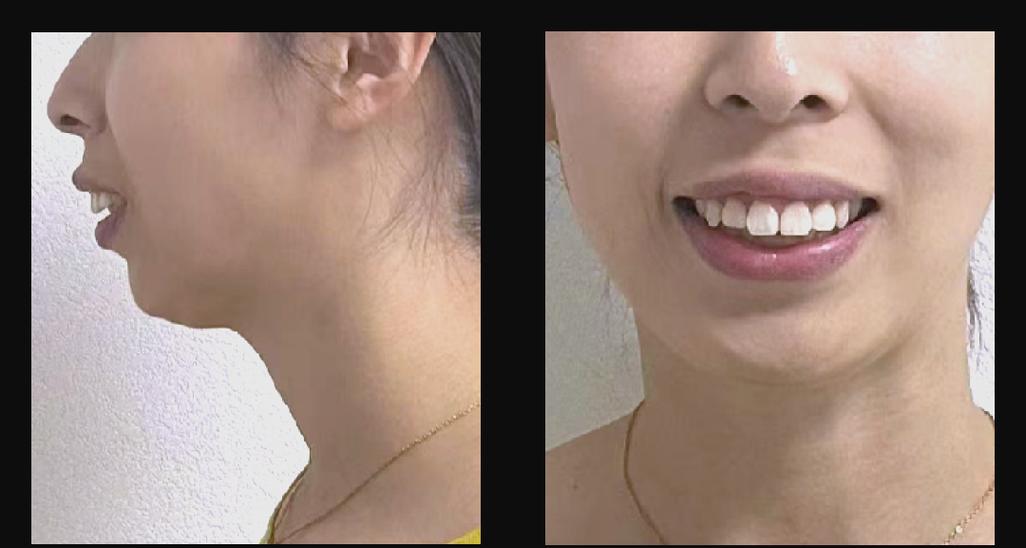 28岁矫正牙齿还来得及吗？-图3