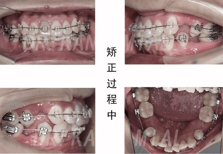 26岁矫正牙齿还来得及吗？-图1