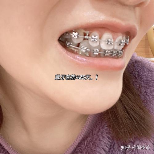 26岁矫正牙齿还来得及吗？-图3