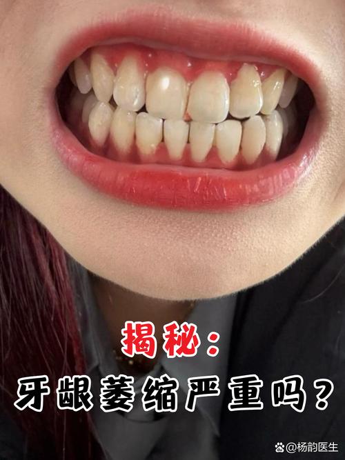 牙齿矫正为何会导致牙龈萎缩？矫正后如何预防？-图1