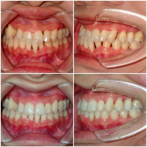 牙齿矫正为何会导致牙龈萎缩？矫正后如何预防？-图2