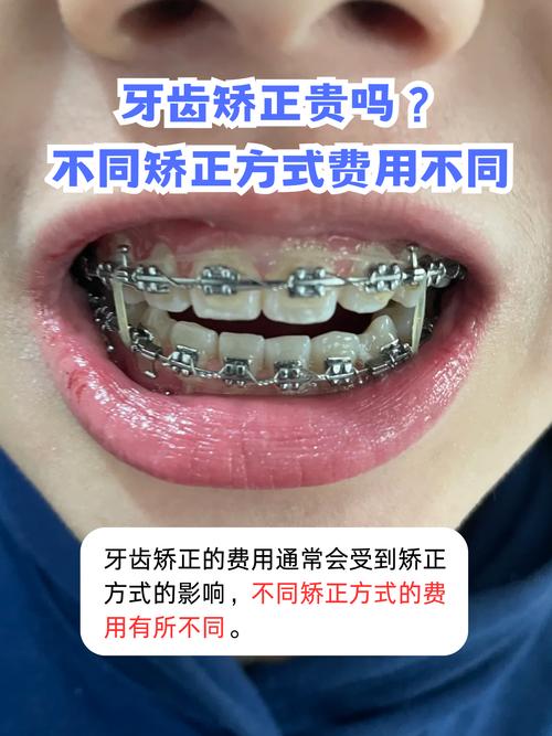 广州牙齿矫正哪里便宜?性价比高的机构怎么选?-图2 广州牙齿矫正哪里便宜?性价比高的机构怎么选?-图2