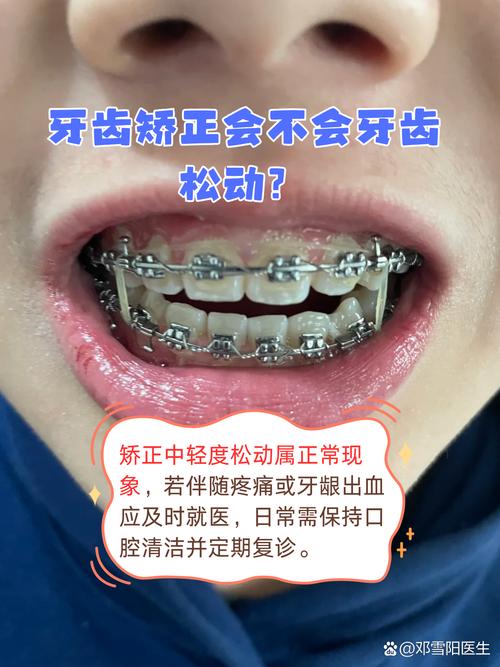 矫正期间牙齿松动怎么办？会影响最终矫正效果吗？-图1