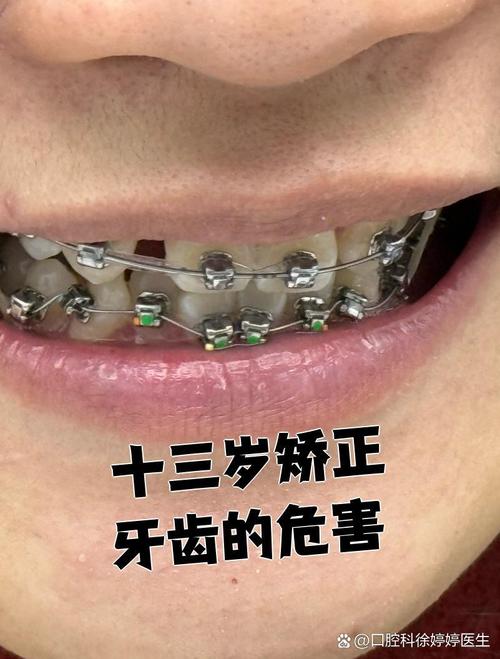 矫正期间牙齿松动怎么办？会影响最终矫正效果吗？-图2