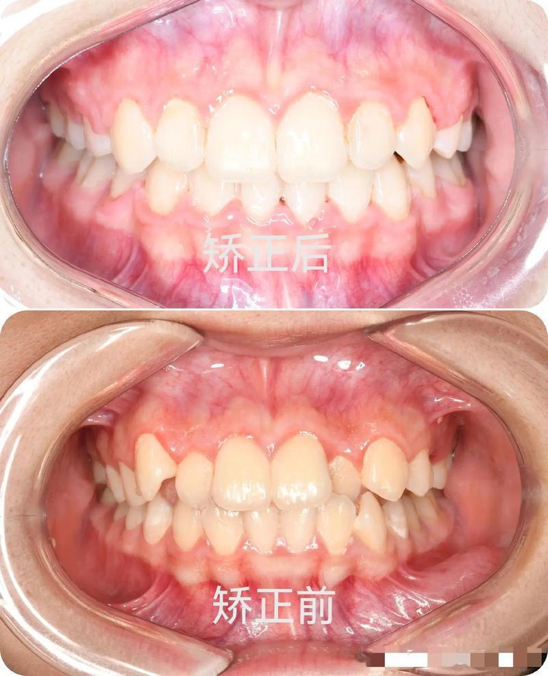 矫正牙齿一般拔几颗牙?数量因人而异还是固定标准?-图3 矫正牙齿一般拔几颗牙?数量因人而异还是固定标准?-图3