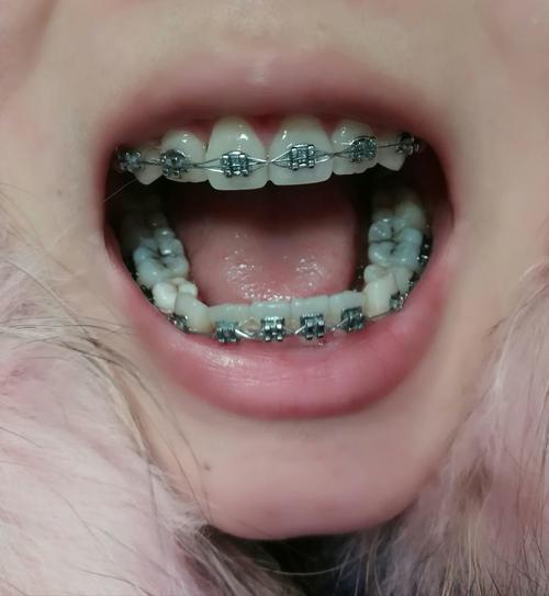 13岁矫正牙齿拔4颗-图1