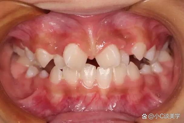 矫正牙齿的危害青少年-图1