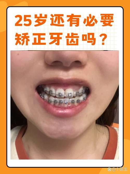 25岁矫正牙齿，反弹真的无法避免吗？-图3