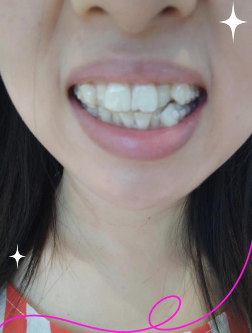 40岁能做牙齿矫正吗？有年龄限制吗？-图1