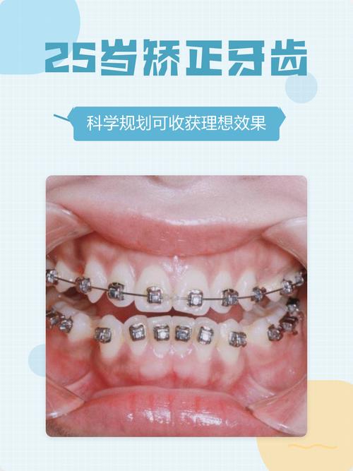 25岁矫正牙齿还来得及吗?-图1 25岁矫正牙齿还来得及吗?-图1