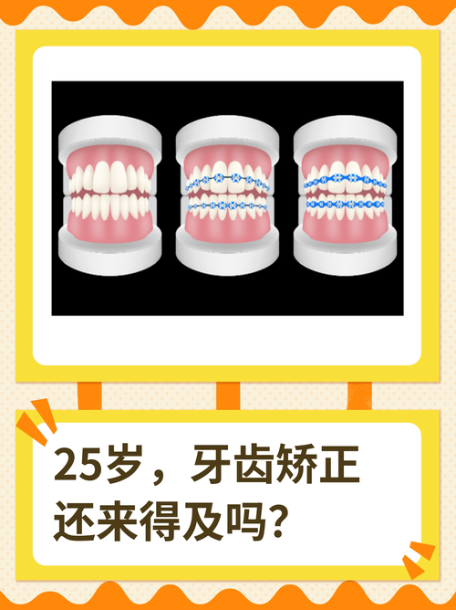 25岁矫正牙齿还来得及吗?-图2 25岁矫正牙齿还来得及吗?-图2
