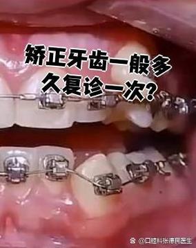 矫正牙齿复诊间隔多久一次合适?-图2 矫正牙齿复诊间隔多久一次合适?-图2