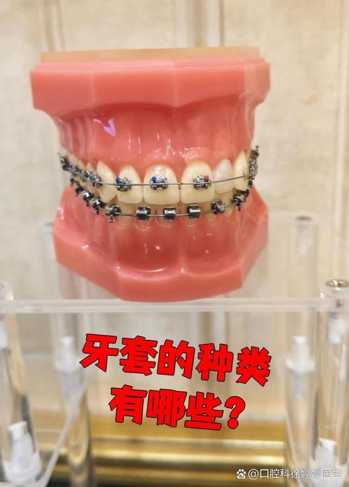 牙齿矫正牙套有几种？常见类型及优缺点有哪些？-图1