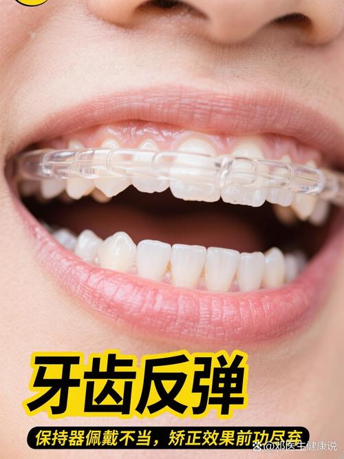 矫正牙齿后保持器到底要戴多久？-图1