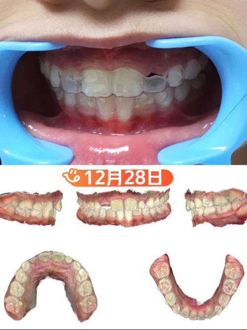 矫正牙齿后保持器到底要戴多久？-图2