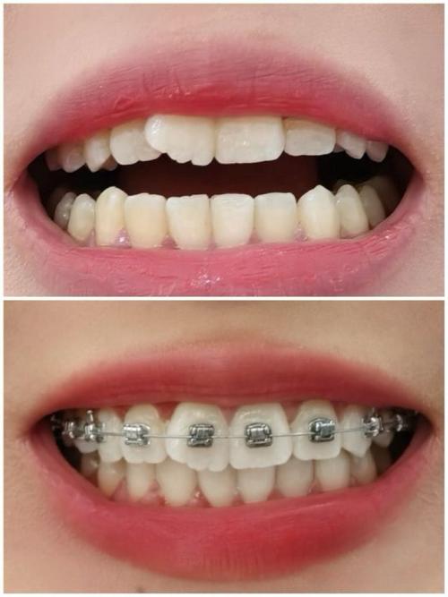 26岁做牙齿矫正来得及吗?年龄大会不会影响效果和矫正周期?-图2 26岁做牙齿矫正来得及吗?年龄大会不会影响效果和矫正周期?-图2