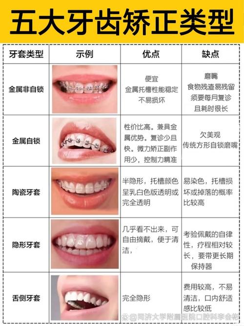 矫正牙齿的方法有哪些？-图1