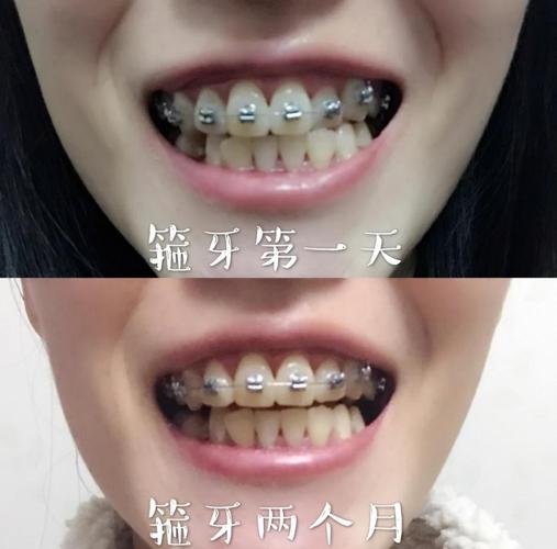 26岁矫正牙齿还来得及吗?成年人矫正有年龄限制吗?-图2 26岁矫正牙齿还来得及吗?成年人矫正有年龄限制吗?-图2