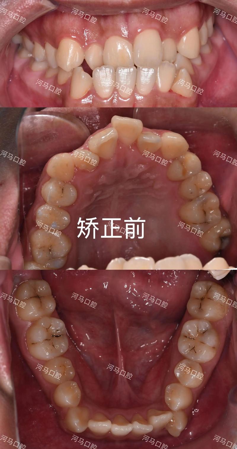23岁还可以牙齿矫正-图1