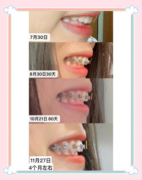 23岁还可以牙齿矫正-图2